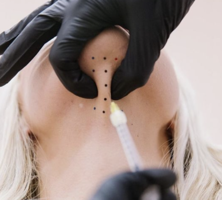 The KYBELLA™ Experience at Vixen Aesthetics